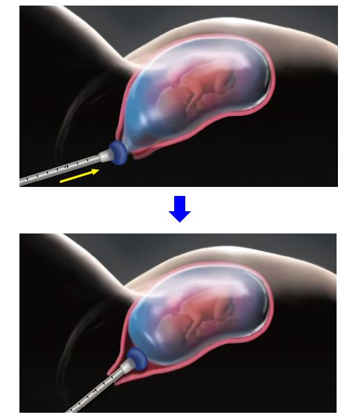 Lee's Cerclage Balloon