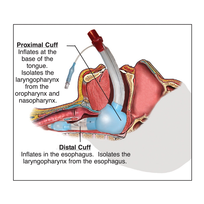 Laryngeal Tube